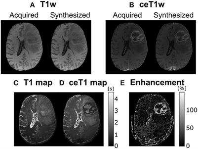 Toward deep learning replacement of gadolinium in neuro-oncology: A review of contrast-enhanced synthetic MRI